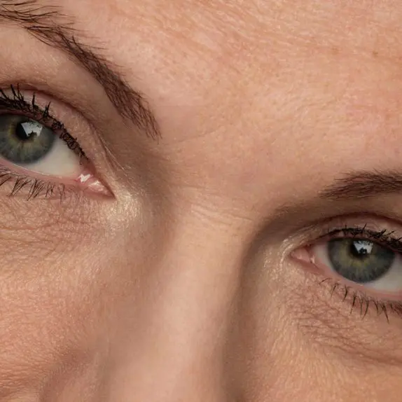 Blepharoplasty