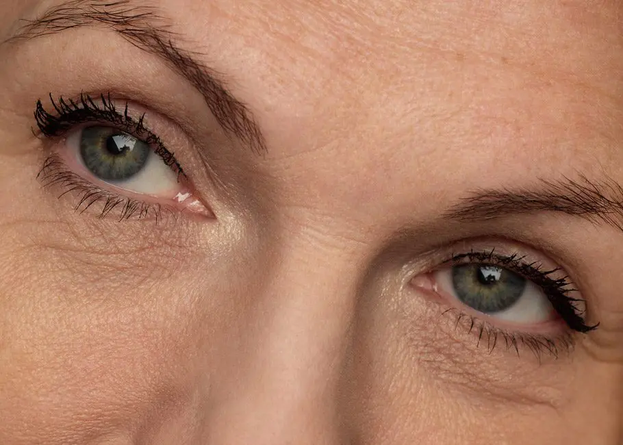 Blepharoplasty