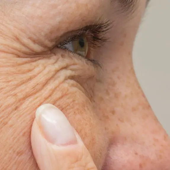 Facial Lines & Wrinkles