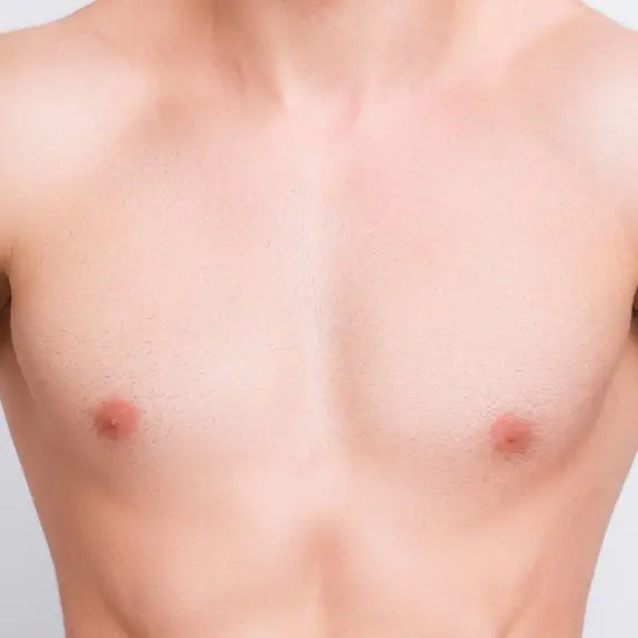 Gynaecomastia