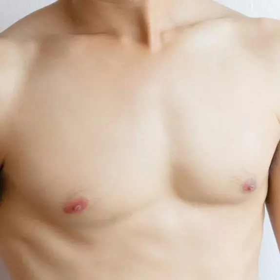 Gynaecomastia Correction