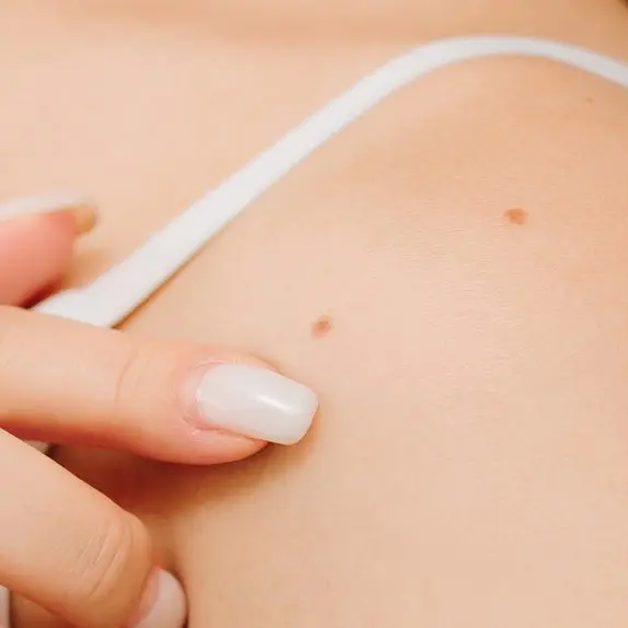 Mole Check & Mole Removal