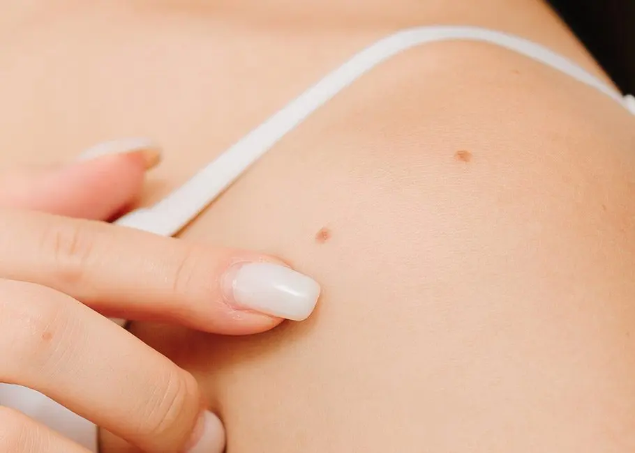 Mole Check & Mole Removal