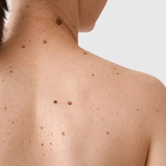 Skin Cancers (BCC, SCC, Melanoma)