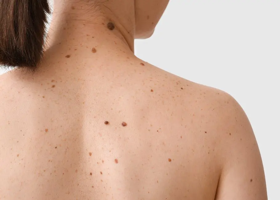 Skin Cancers (BCC, SCC, Melanoma)