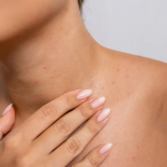 Skin Tags