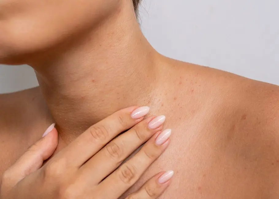 Skin Tags