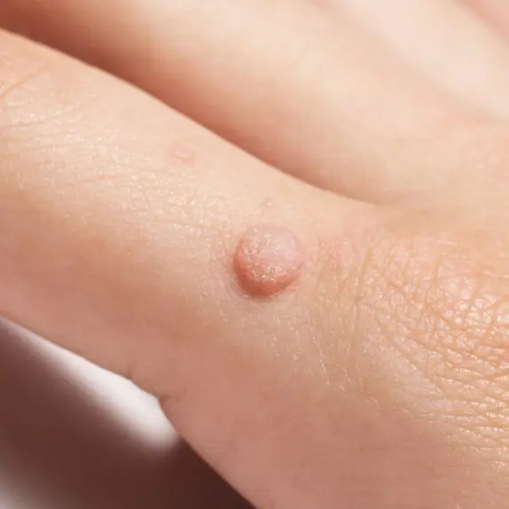 Warts & Verrucae