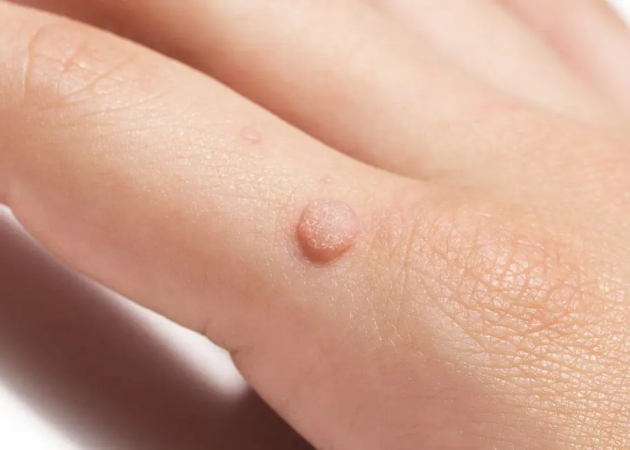 Warts & Verrucae
