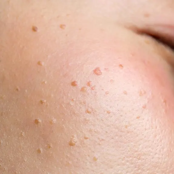 Seborrhoeic Keratosis Removal