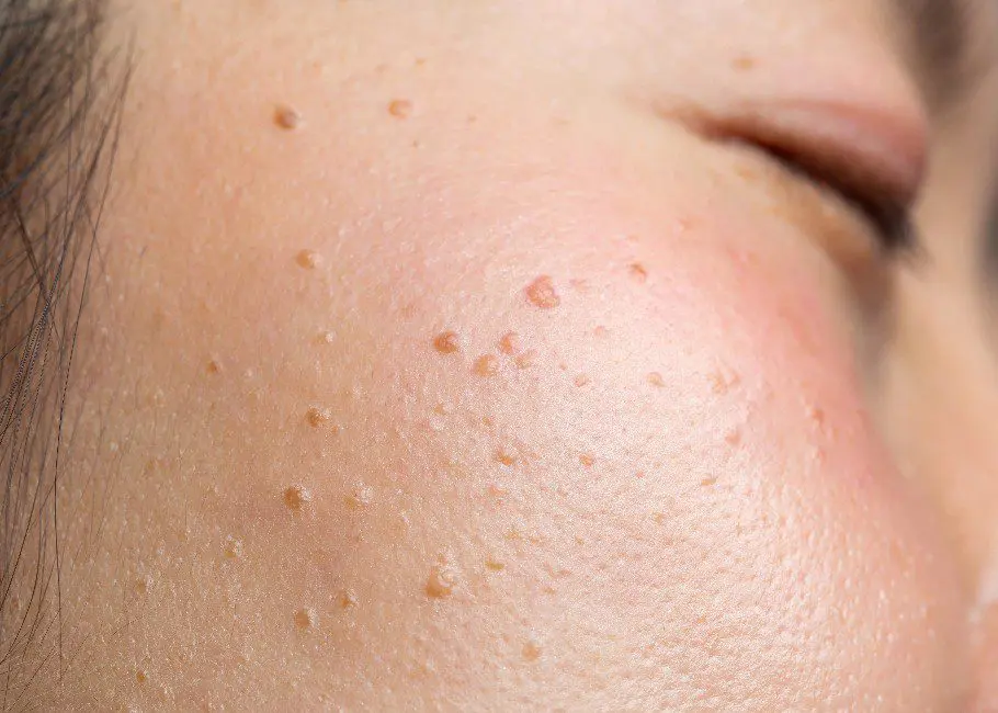 Seborrhoeic Keratosis Removal