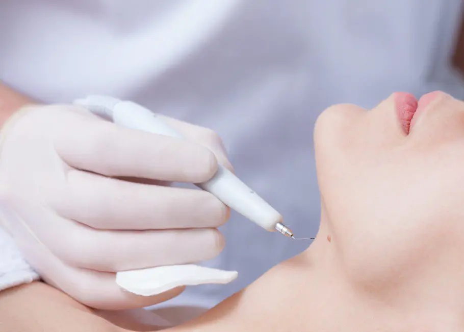 Warts and Verrucae Removal