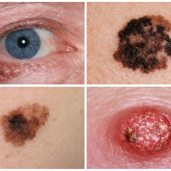 Skin Cancer Removal