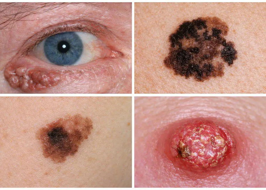 Skin Cancer Removal
