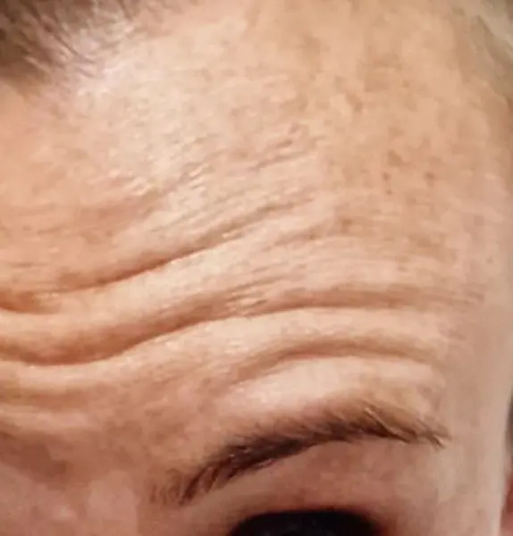Wrinkle Reduction Before