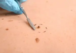 Curettage and Cautery