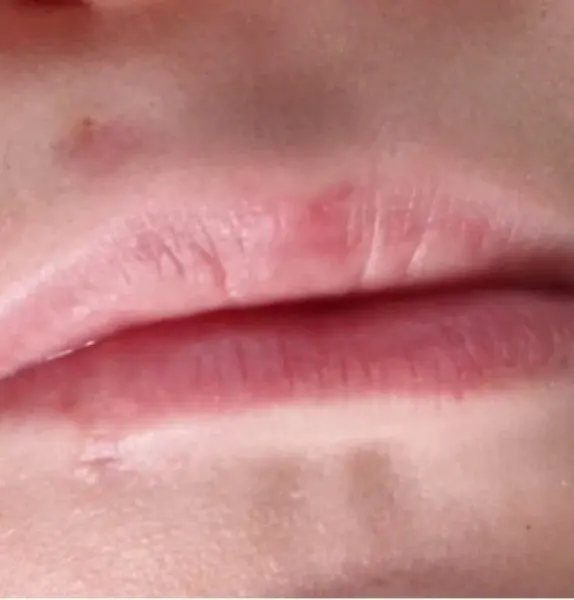 Mole Removal After