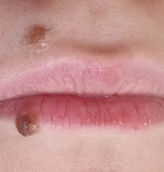 Mole Removal Before