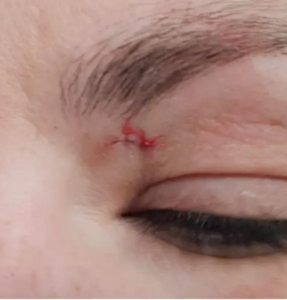 Mole Removal After Kirbha Clinic
