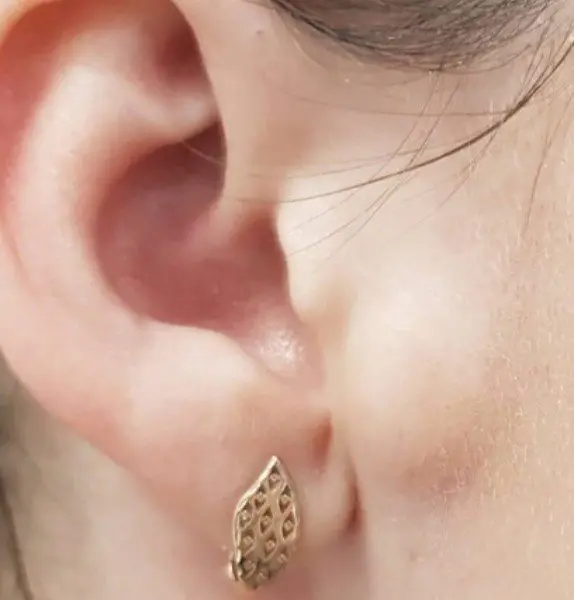 Sebaceous Cyst Removal Before Kirbha Clinic