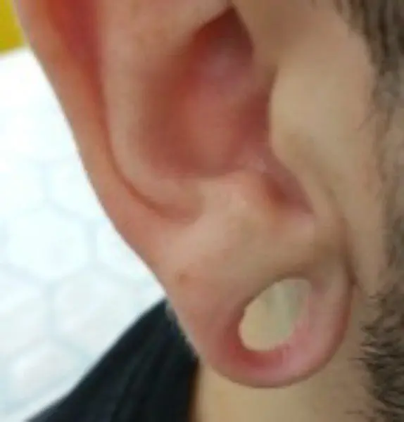 Ear Lobule Repair Before Kirbha Clinic