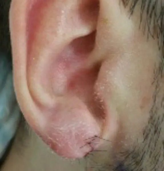 Ear Lobule Repair After Kirbha Clinic