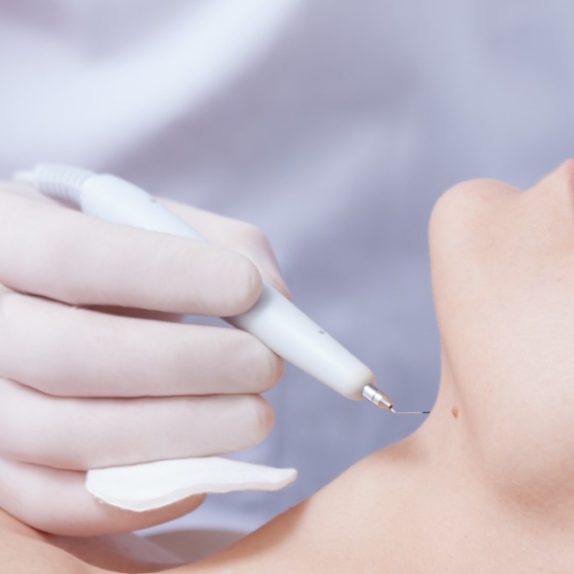 Warts and Verrucae Removal
