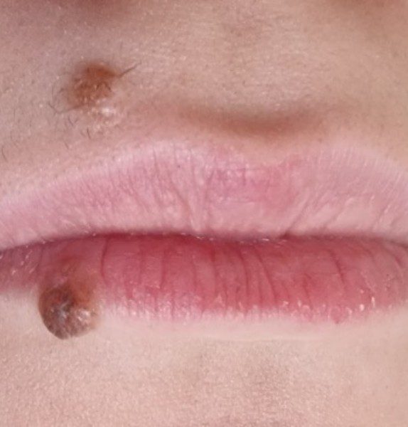 Mole Removal Before