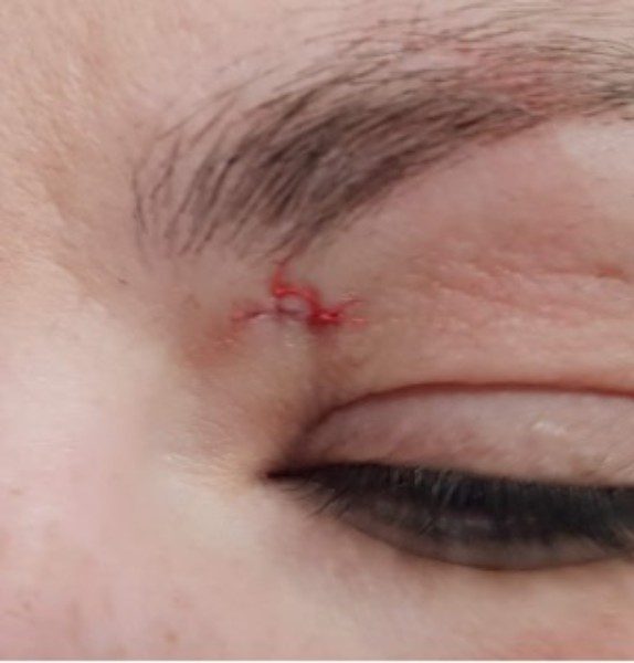 Mole Removal After Kirbha Clinic
