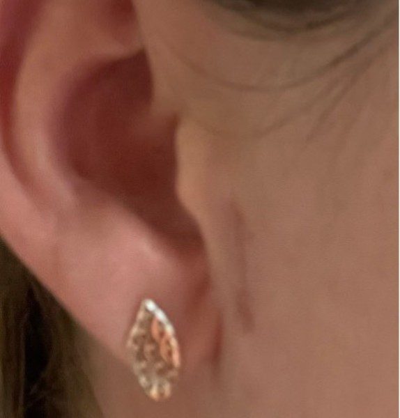 Sebaceous Cyst Removal After Kirbha Clinic