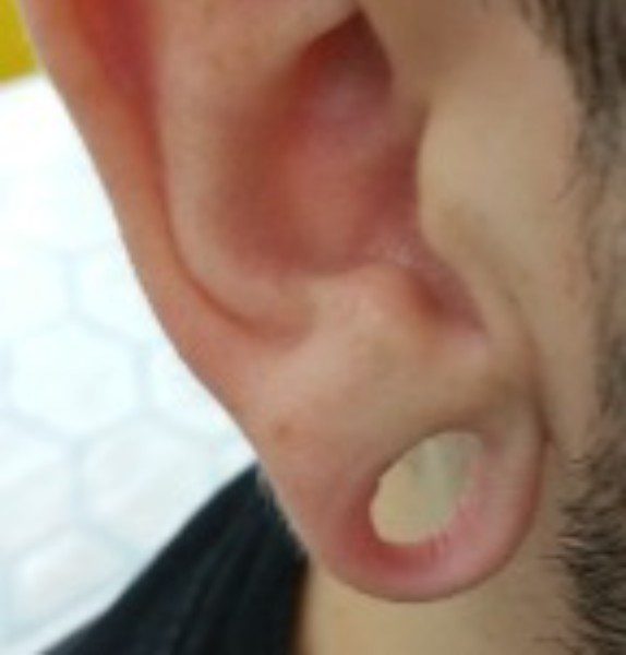 Ear Lobule Repair Before Kirbha Clinic